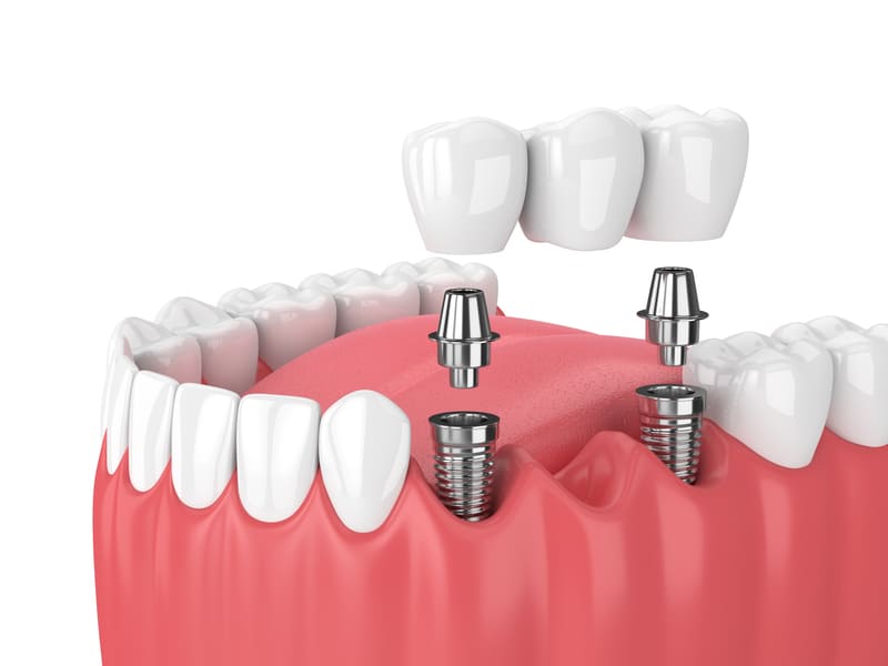 vantagens dos Implantes Dentários